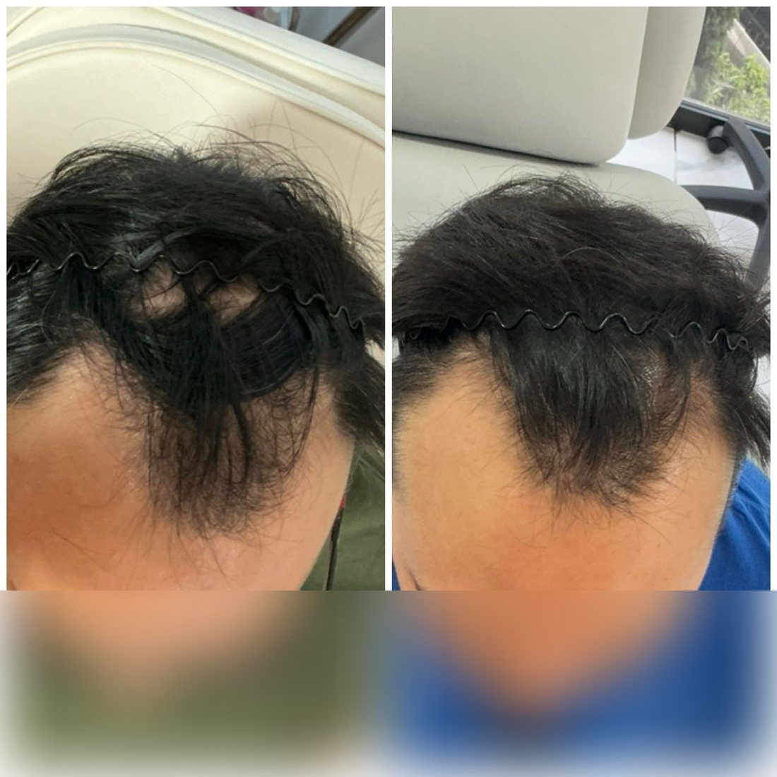 Antes y después de microinjerto capilar FUE en Haarmonia