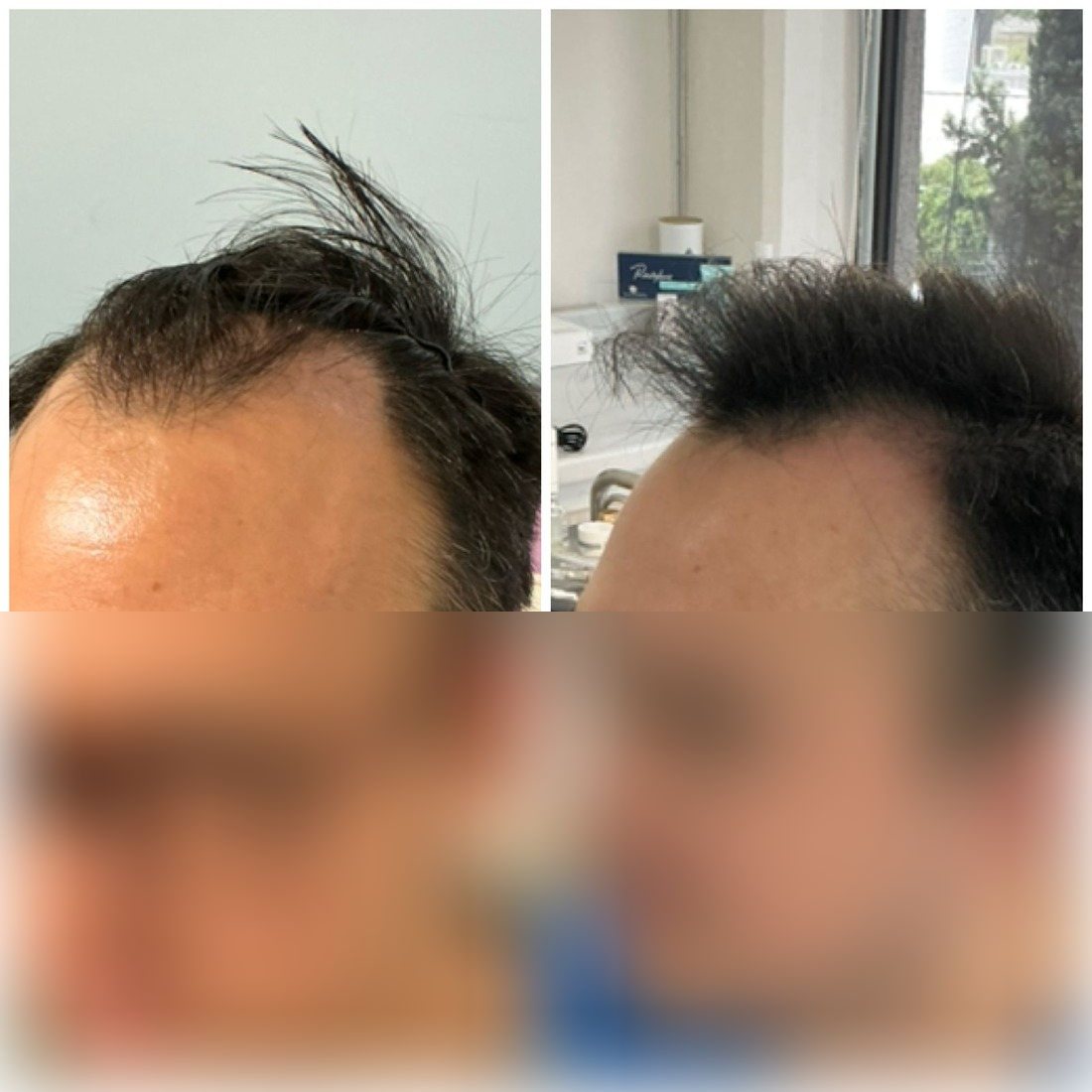 Antes y después de microinjerto capilar FUE, paciente real de Haarmonia