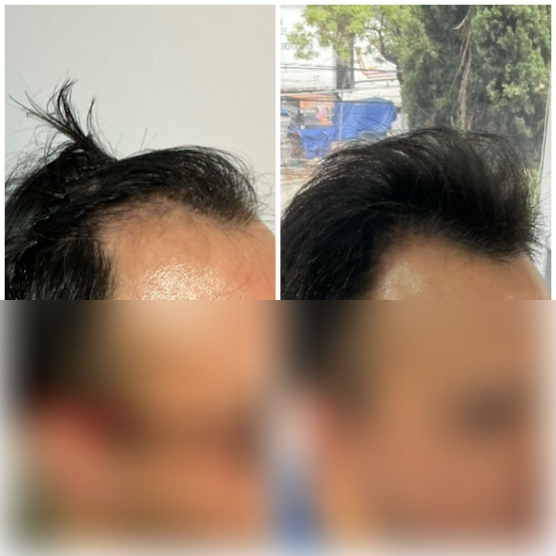 Antes y después de microinjerto capilar FUE, paciente real de Haarmonia
